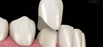 آیا دندان روکش شده خراب می شود ؟