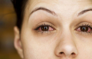 علائم و درمان سندرم التهابی چشم با نام سودوتومور اربيت