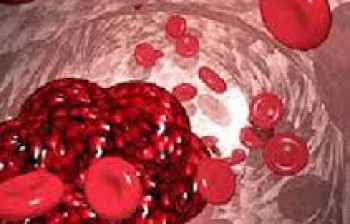 آمبولی مایع آمنیوتیک وانسداد رگهای مادر در موقع زایمان