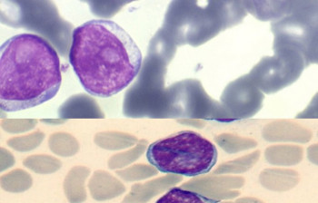 لنفوسیتوز (Lymphocytosis)چیست؟