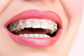 حرکات دندان در دوران درمان ارتودنسی چگونه انجام میشود؟