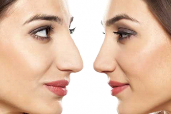 ریسک جراحی بینی و انواع روش های مختلف عمل زیبایی بینی