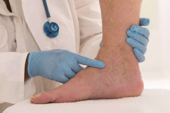 لخته شدن خون در پا نشانه چه بیماری است ؟ + علت لخته خون در پا