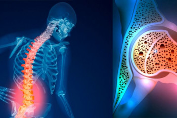 داروهای ایجاد کننده پوکی استخوان