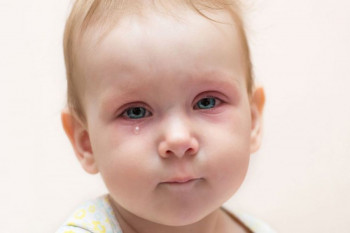 عوارض آبریزش چشم و درمان های خانگی فوق العاده آبریزش چشم نوزادان