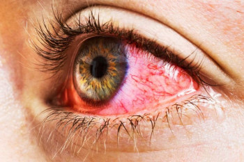 قرمزی چشم چیست و علل به وجود آمدن و راه های درمان آن چیست ؟