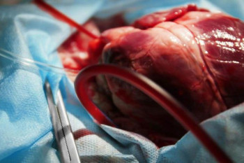 جراحی پیوند قلب چطوری است؟