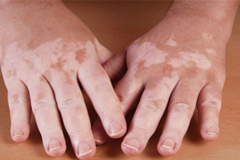 درمان ویتیلیگو با رژیم غذایی و سایر روش های درمان این بیماری پوستی
