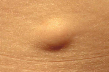 لیپوما یا همان غده چربی زیر پوستی ؛ علل، علائم و روش های درمان آن