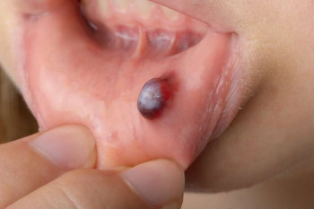 تاول خونی دهان: ۱۱ روش خانگی موثر برای درمان تاول خونی دهان