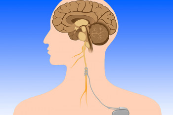فرآیند تحریک عصب واگ چیست؟