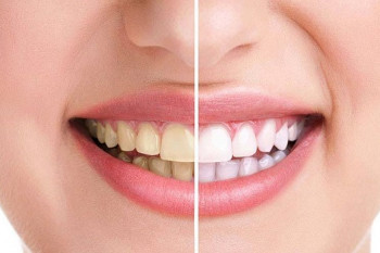 3 روش ساده و خانگی برای جرم گیری دندان ها