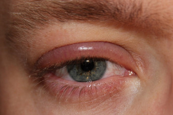 حساسیت پلک چشم و روشهای درمان آن