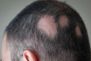 فواید تزریق تریامسینولون در سر برای درمان ریزش مو
