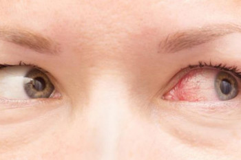 عفونت چشم و راههای ساده پیشگیری از آن