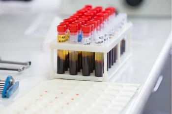علت بالا و پایین بودن ویتامین B۱۲ در آزمایش خون