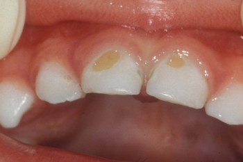 هر آنچه که از رویش تا پوسیدگی دندان باید بدانید