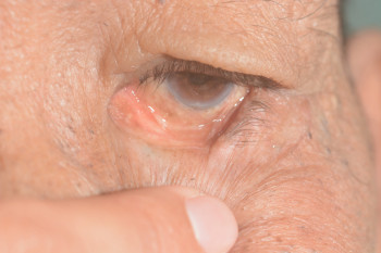 انتروپيون چیست ؟ علت برگشت پلک به داخل چشم چیست ؟
