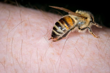 نیش زنبور : اقدامات پس از گزیدگی نیش زنبور