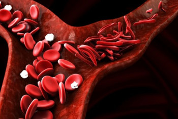 علائم کم خونی داسی شکل چیست و چگونه درمان میشود ؟