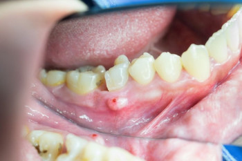 ۶ راهکار تاثیر گذار خانگی برای درمان عفونت دندان