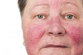 ۱۵ درمان خانگی موثر برای قرمزی پوست
