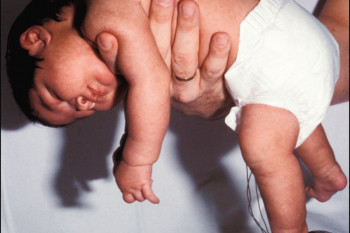 علائم و راههای درمان هیپوتونی (ضعف عضلات نوزاد) چیست ؟