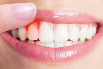 سوزش لثه نشانه چیست و چگونه درمان میشود ؟