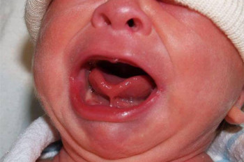 چسبندگی زبان نوزاد : علائم و راههای درمان چسبندگی زبان به کف دهان