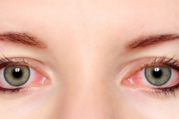 علت و راههای پیشگیری از قرمز شدن چشم چیست ؟