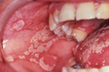 عوامل تشدید کننده بیماری برفک یا کاندیدیاز دهانی‌ چیست ؟