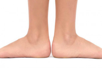برای درمان کف پای صاف به چه دکتری باید مراجعه کرد ؟