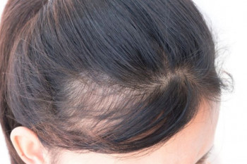 چگونه از پیاز برای درمان طاسی سر و ریزش مو استفاده کنم ؟