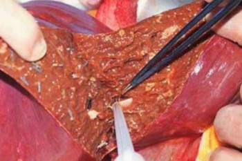 متاستاز کبد چیست و چگونه قابل تشخیص است ؟