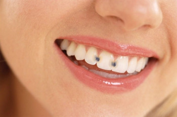 عوارض پوسیدگی دندان : صدمات جبران ناپذیر دندان پوسیده بر سلامت