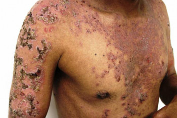 پمفیگوس ولگاریس بدترین بیماری پوستی در کشور