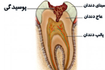 پوسیدگی دندان بیماری شایع درکشور 