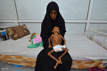 تصاویر کودکان گرسنه یمنی‎