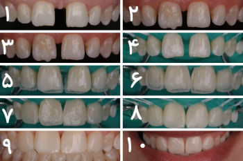 روش بستن فاصله بین دندان ها