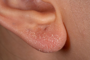 علل و درمان خشکی پوست گوش 