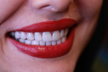  پالیش کامپوزیت دندان چیست ؟