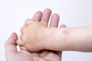 بیماری درماتیت سبوره در کودکان چیست؟