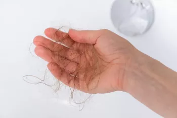 علت ریزش موی آندروژنیک + درمان