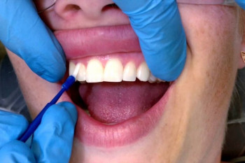 فیشور سیلانت دندان چیست و چه فوایدی دارد؟