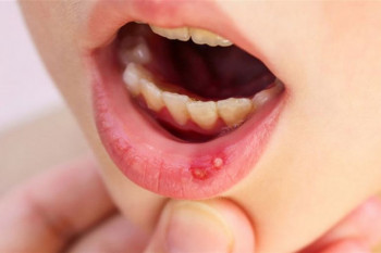 علت تبخال دهانی کودک چیست؟