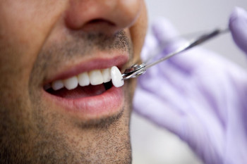 لومینیرز دندان چیست؟ لومینیرز بهتر است یا کامپوزیت