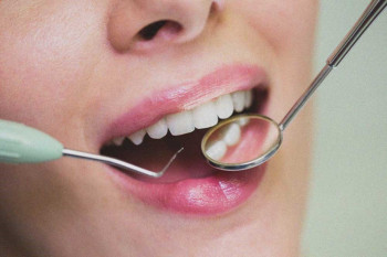 لمینت زیباتر است یا کامپوزیت؟ مسئله این است!