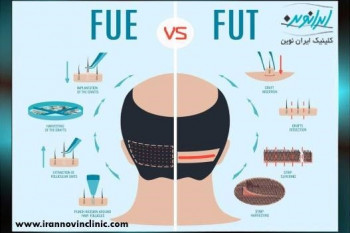 آشنایی با کاشت مو به روش های SUT و FUE، کدام یک بهتر است؟