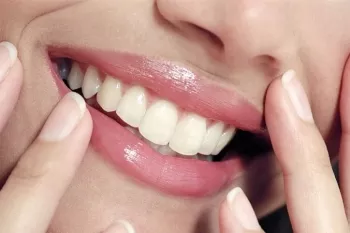 ۵ راه سفید نگه داشتن کامپوزیت دندان