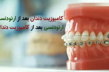 کامپوزیت و ارتودنسی دندان، کدام بهتر است؟ کدام زودتر باید انجام شود؟
